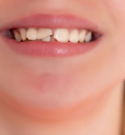 חבלה בשיניים קדמיות - תמונת המחשה